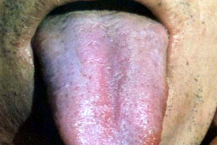 类剥苔图 类剥苔图