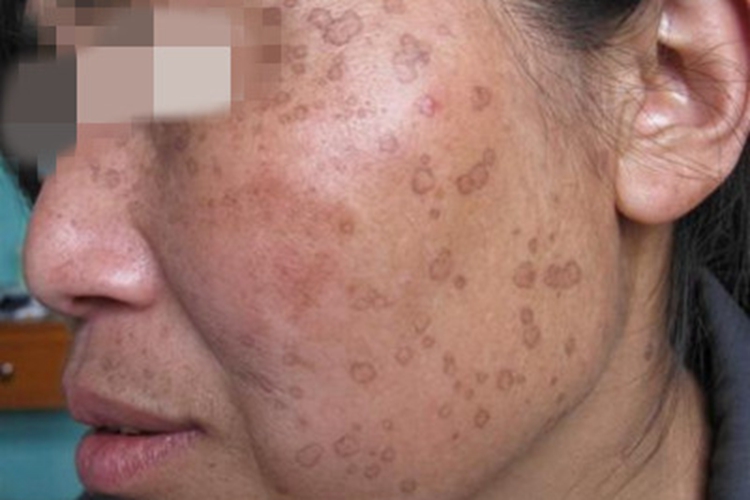 汗孔角化症症状图 汗孔角化症症状图