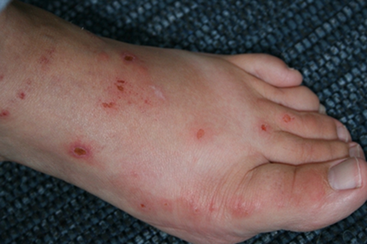 恙螨皮炎脚背红色结痂图