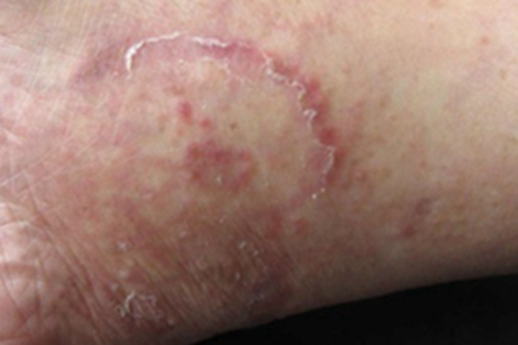 体癣脚踝红斑鳞屑图