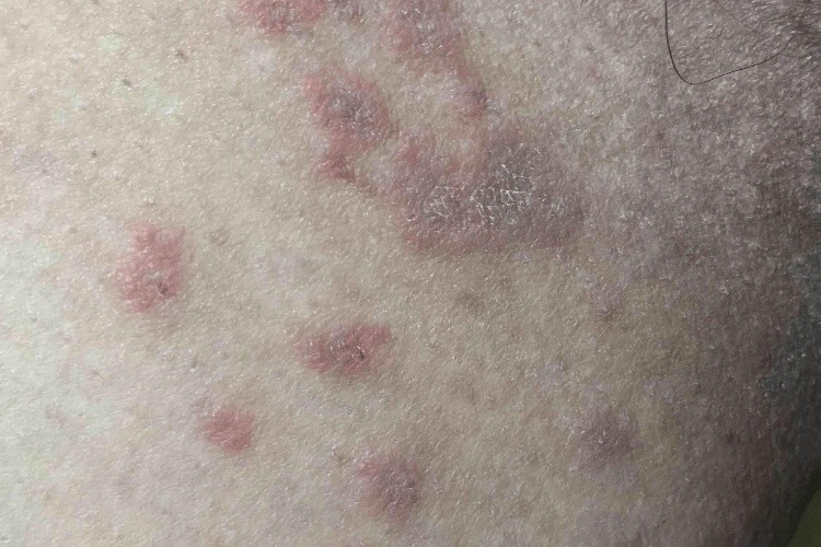 腹股沟慢性湿疹图