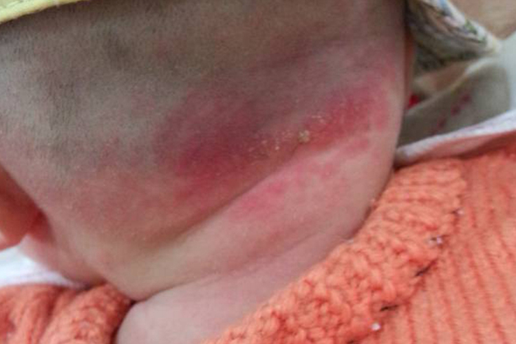 婴儿后脑勺脂溢型湿疹图