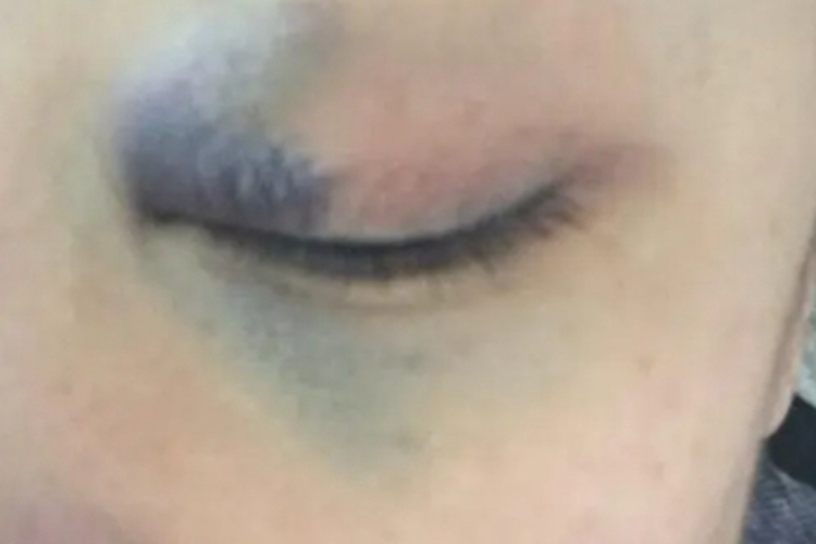 眼眶血肿眼角发青图