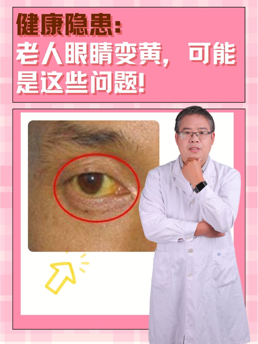 健康隐患：老人眼睛变黄，可能是这些问题！
