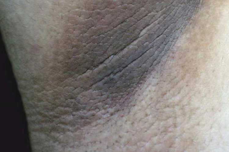 黑棘皮病典型表现图 黑棘皮病典型表现图