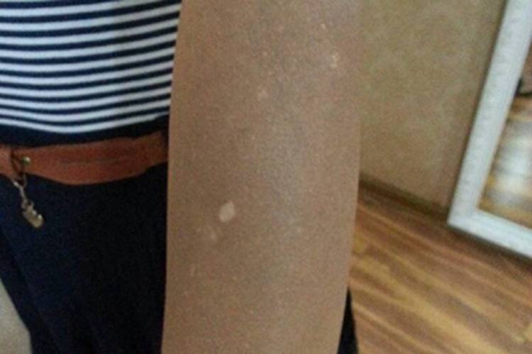 焦油黑变病胳膊皮肤发黑图 焦油黑变病胳膊皮肤发黑图