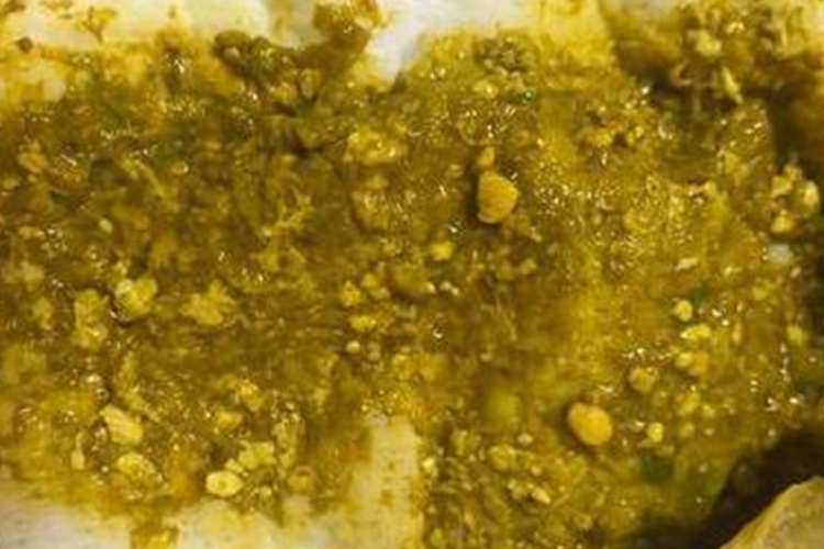 新生儿消化不良大便奶瓣状图 新生儿消化不良大便奶瓣状图