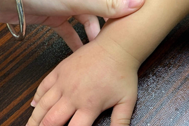 过敏性皮炎皮肤增厚图