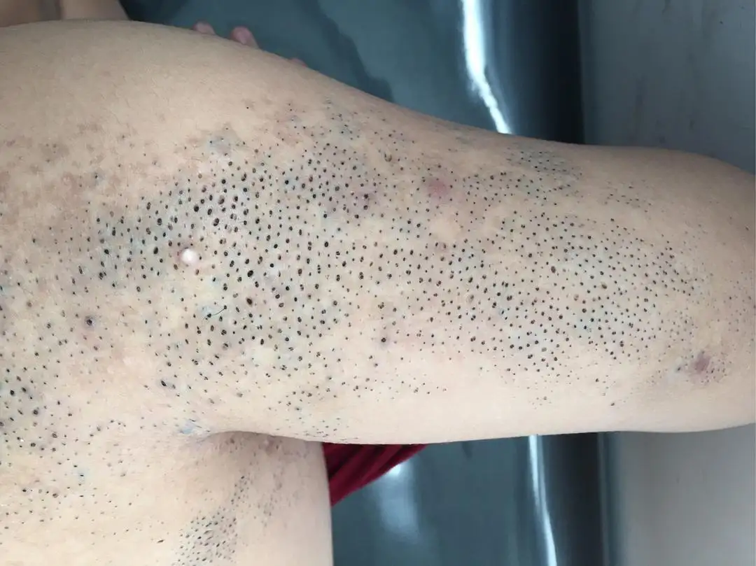 黑头粉刺样痣图 黑头粉刺样痣图