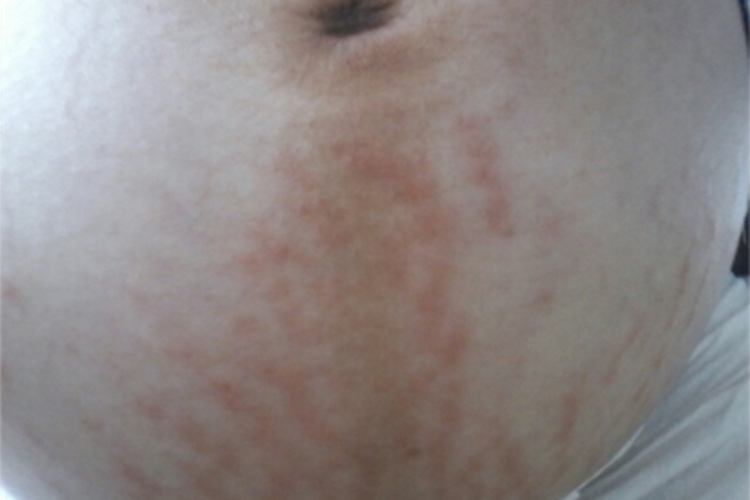 迟发型妊娠痒疹腹部纹图