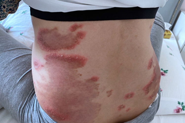 体癣腰部红斑水疱图