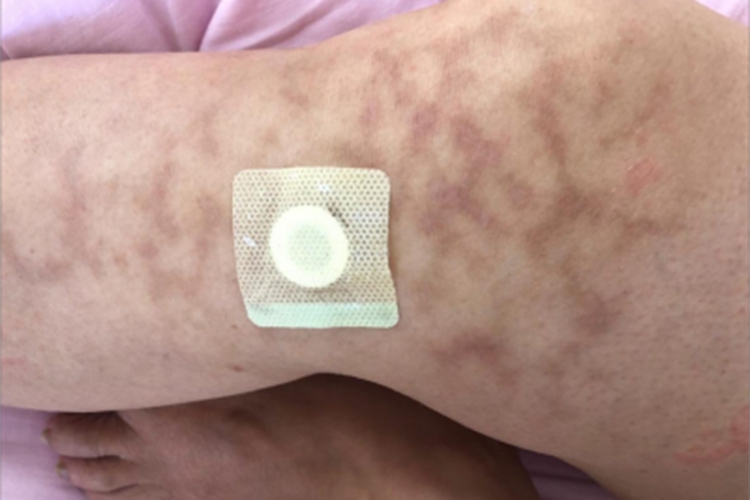 热激红斑症状图