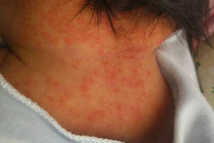 湿疹型药疹颈部红斑图