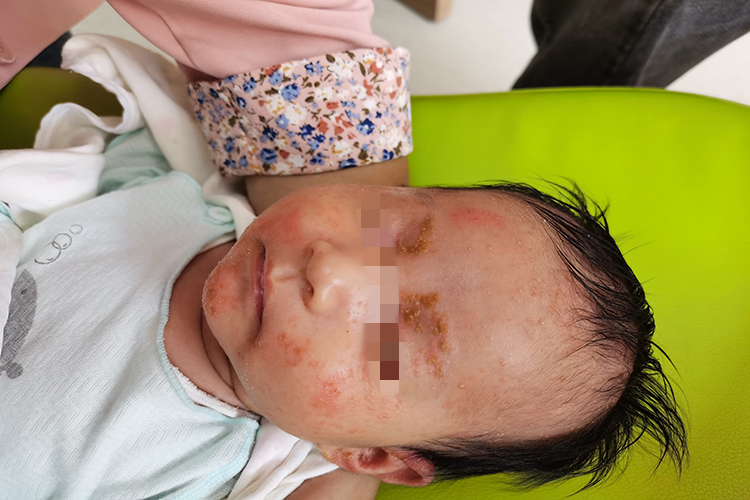 孩子口面部湿疹图