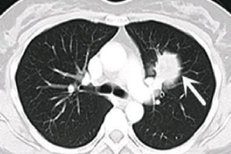 肺霉菌感染CT图