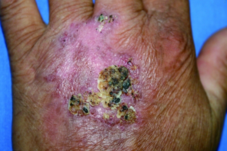 着色真菌病手背斑块图 着色真菌病手背斑块图