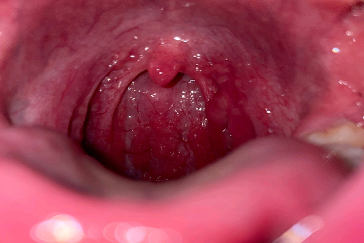 慢性单纯性咽炎症状图 慢性单纯性咽炎症状图