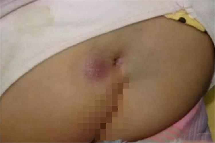 骶尾部藏毛窦脓包图