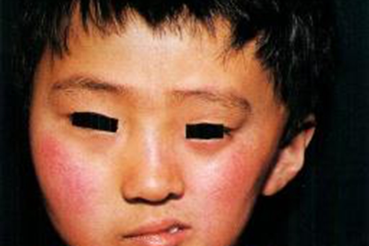 进行性肌营养不良下巴萎缩图