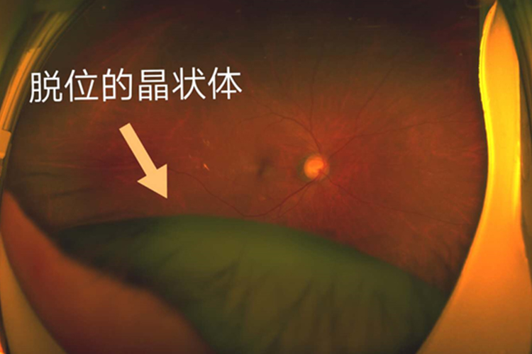 晶状体全脱至前房内图