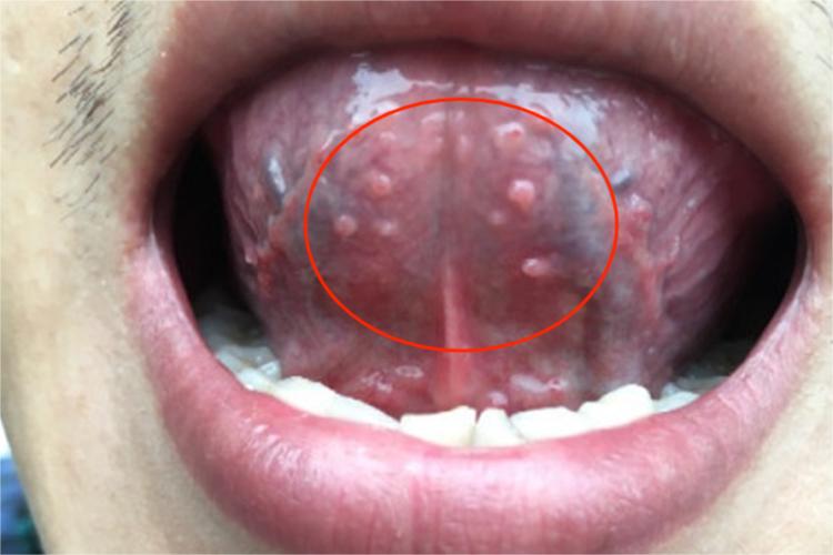 舌下尖锐湿疣图