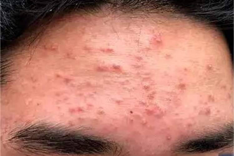痤疮额头长了一片小疙瘩图