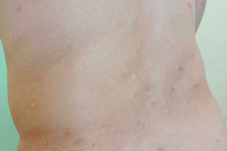 玫瑰糠疹红疹图