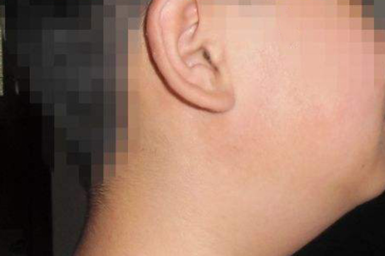 慢性复发性腮腺炎局部肿大图 慢性复发性腮腺炎局部肿大图