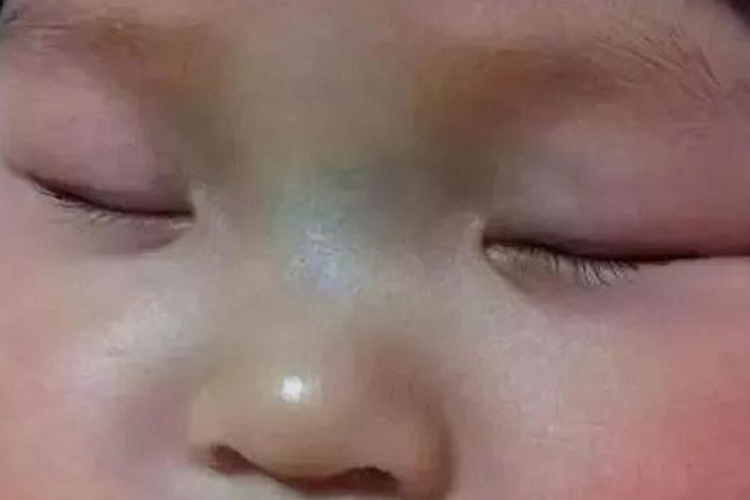 新生儿马鞍鼻正常现象图 新生儿马鞍鼻正常现象图