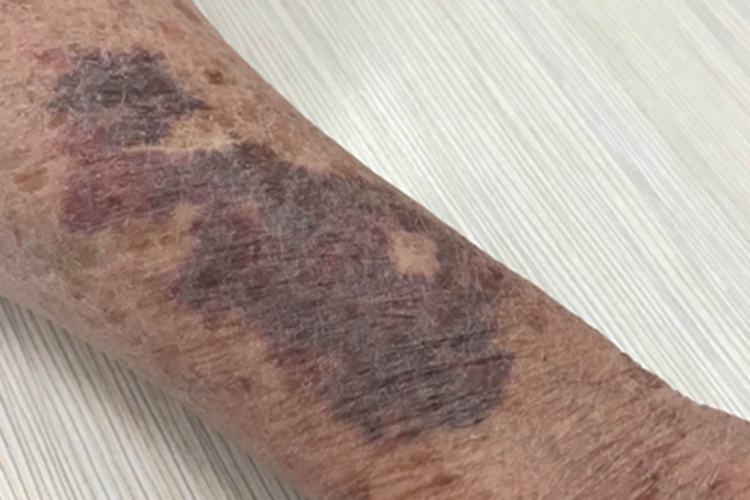 老年性皮肤萎缩胳膊紫斑图 老年性皮肤萎缩胳膊紫斑图