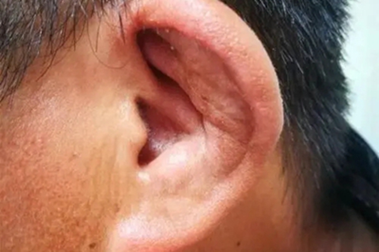 复发性多软骨炎耳廓皮肤粗糙图