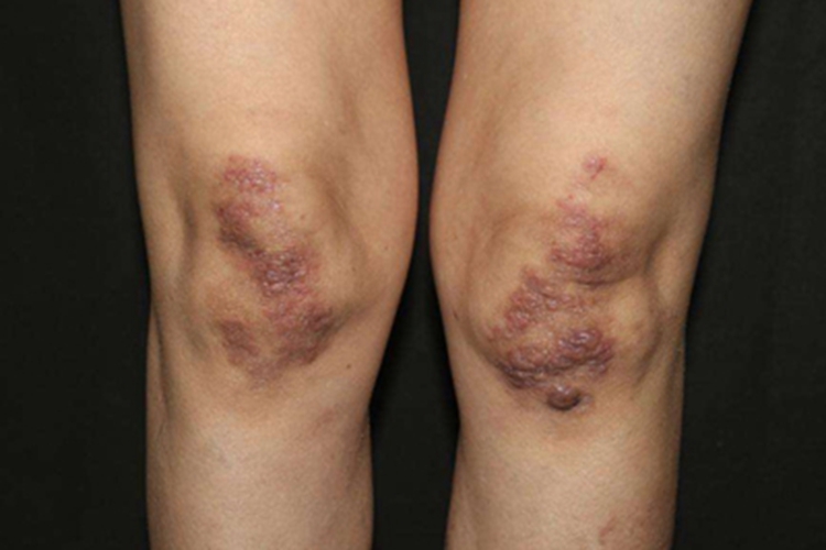 持久隆起性红斑膝盖长斑图