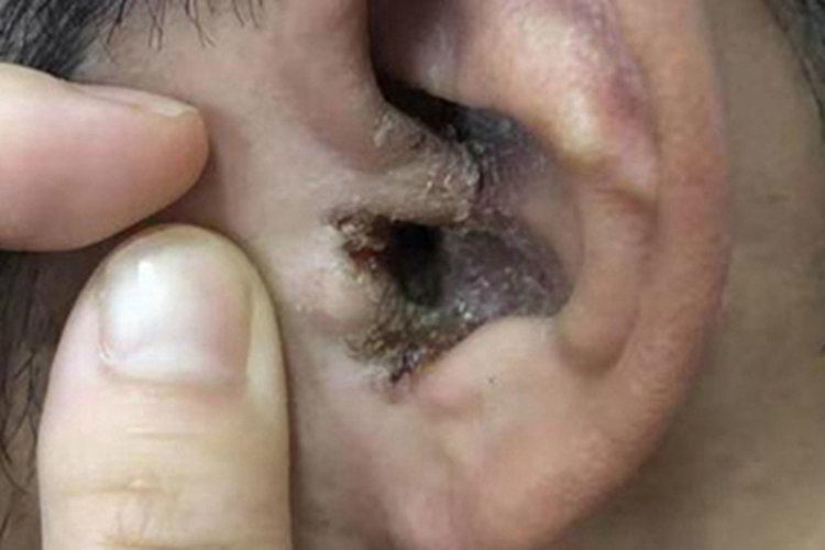 霉菌性外耳道炎结痂图