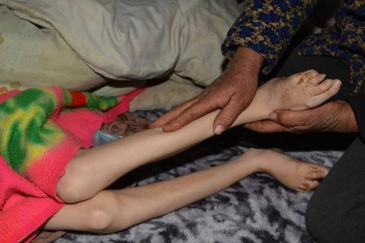 枯萎消瘦图 枯萎消瘦图