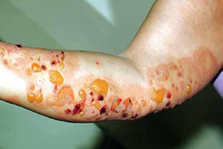 疱疹样天疱疮胳膊症状图 疱疹样天疱疮胳膊症状图