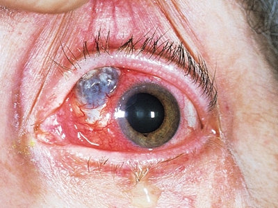 坏死性前巩膜炎眼睛发红有蓝色大疙瘩图.jpg