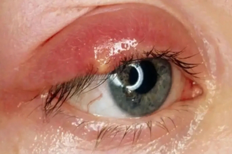 急性眼睑湿疹眼睑红肿图