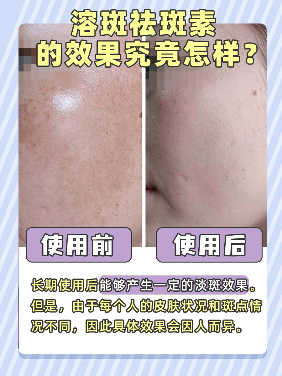 揭秘溶斑祛斑素:它的效果究竟有多惊艳?