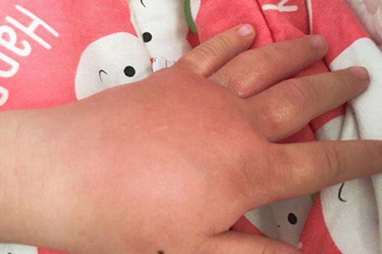 淋巴丝虫病手背红肿图 淋巴丝虫病手背红肿图