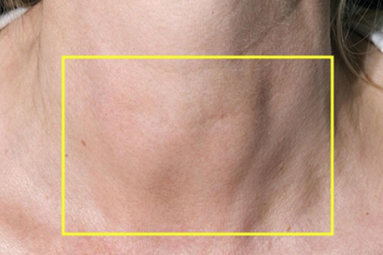 桥本甲状腺炎颈部症状图 桥本甲状腺炎颈部症状图