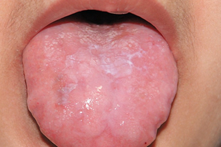 先天性角化不良舌头症状图