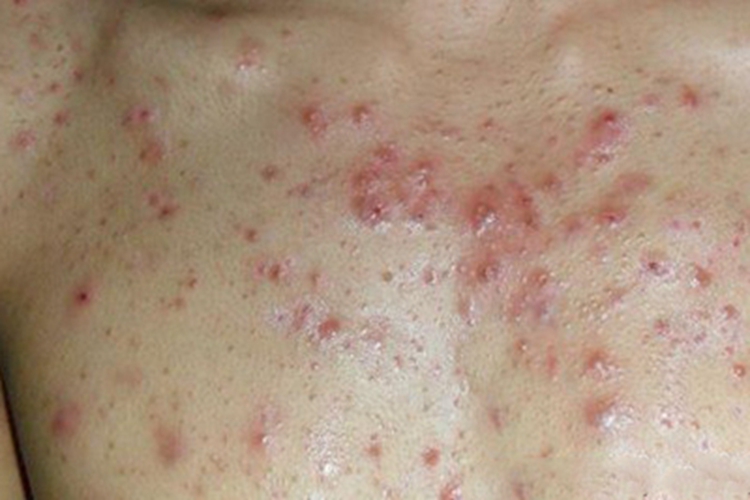 聚合性痤疮胸部大片红疙瘩图