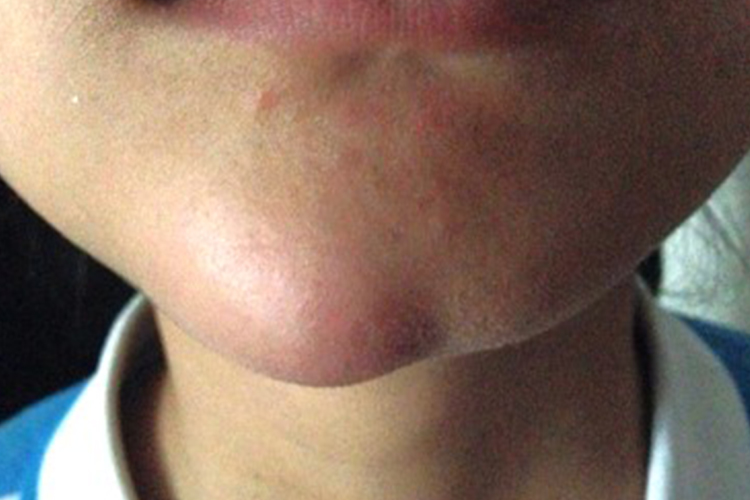 孩子右下巴蜂窝织炎图 孩子右下巴蜂窝织炎图