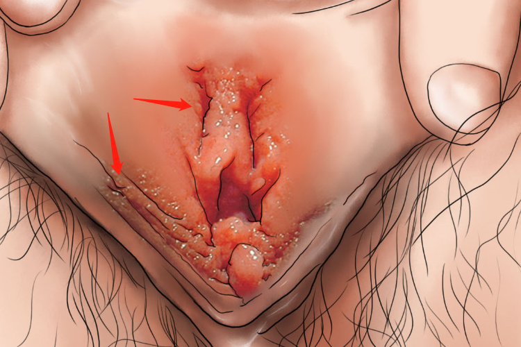 假性湿疣鱼籽状皮损图