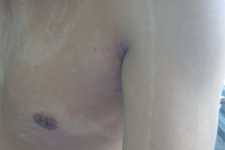 特发性滴状色素减少症胸部条纹图