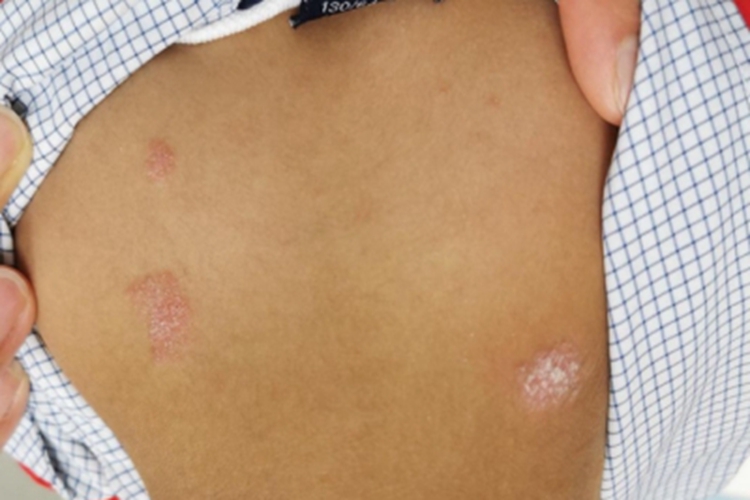 急性点滴型儿童银屑病背部脱屑图