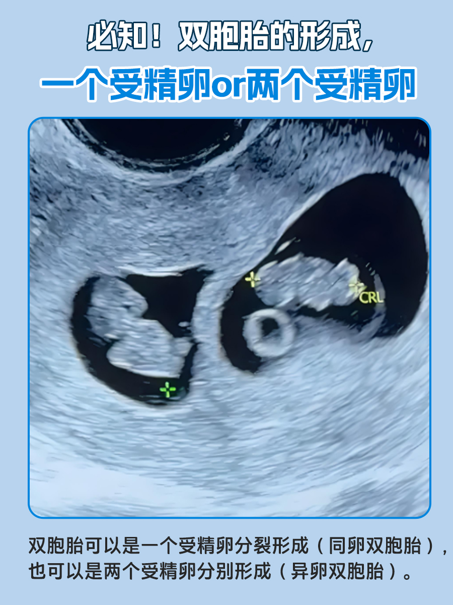 必知!双胞胎的形成,一个受精卵or两个受精卵