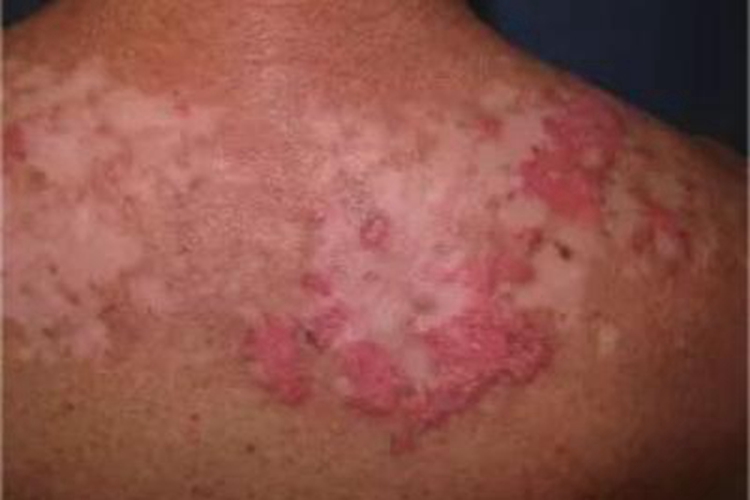 亚急性皮肤型红斑狼疮症状图