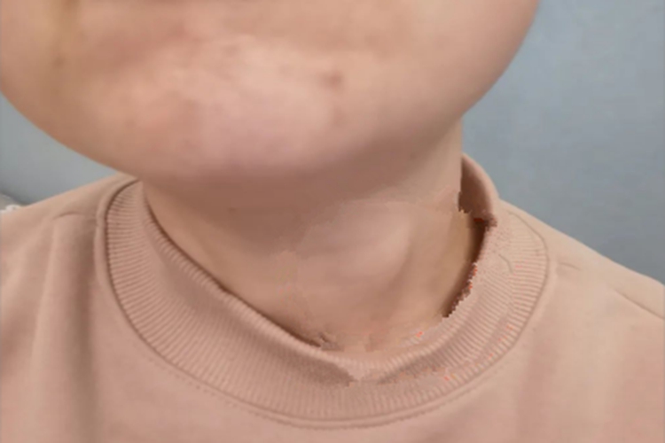 单纯性甲状腺肿侧颈包块图 单纯性甲状腺肿侧颈包块图