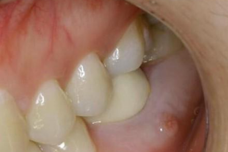 慢性根尖周炎牙龈脓疱图